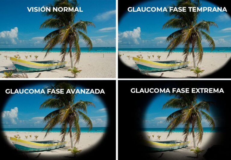 La Unidad de Oftalmología y Catarata lanza campaña informativa y preventiva en ocasión del Día Mundial del Glaucoma